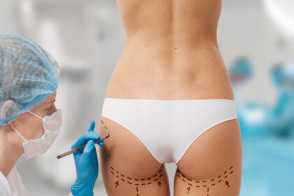 bbl chirurgie