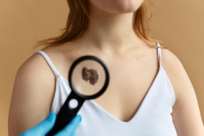 Grain de beauté suspect : à quel moment consulter un dermatologue ?