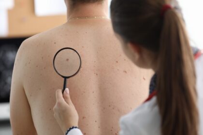 Enlever un grain de beauté : à propos de la chirurgie et ses résultats